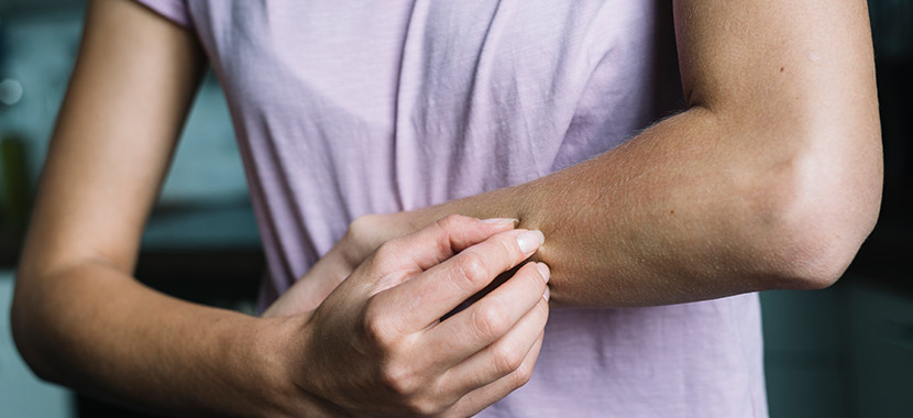 Produtos naturais para diminuir coceira